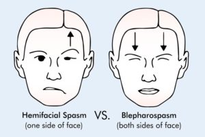 hemifacial spasm causes symptoms