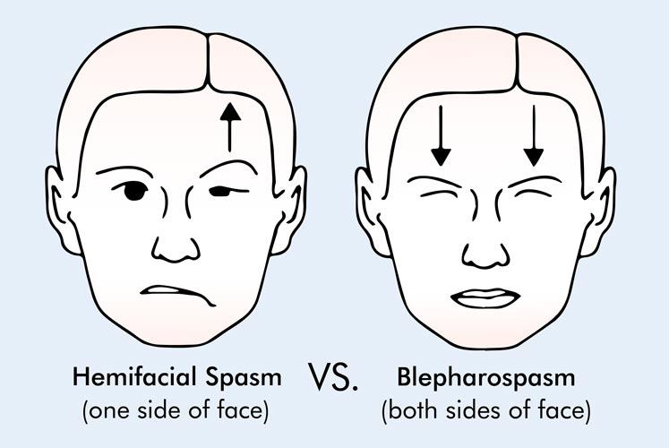 hemifacial-spasm-causes-and-symptoms