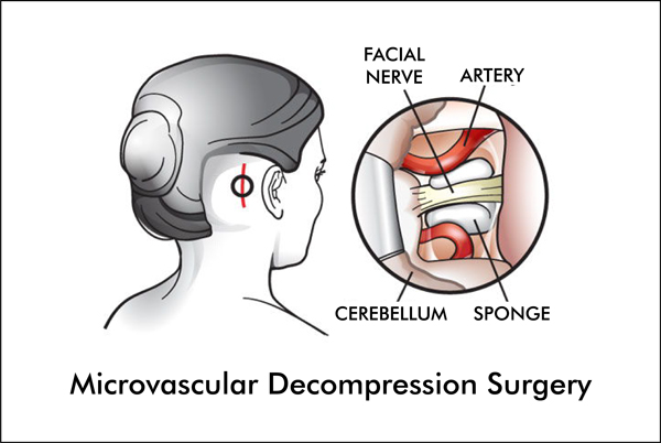 Hemifacial Spasm Diagnosis And Treatment 